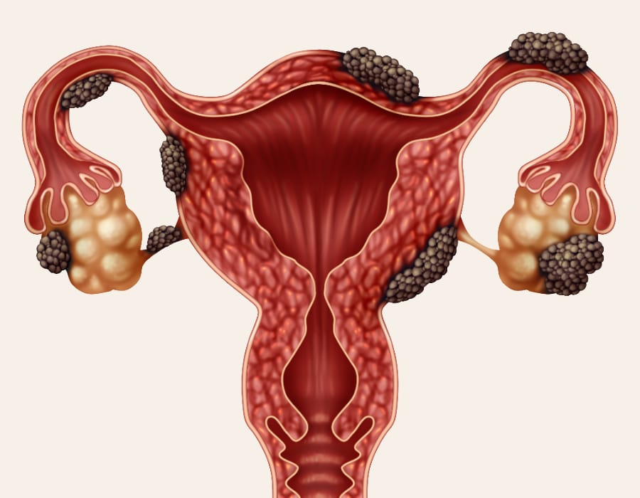 Endometriosis Perth Women's Health